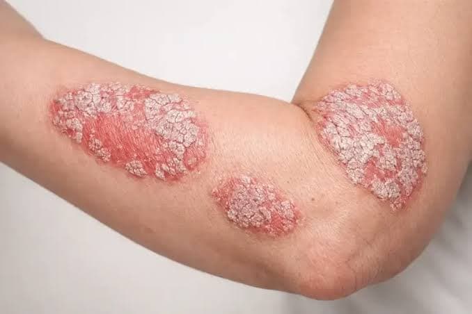 علل بروز پسوریازیس چیست؟