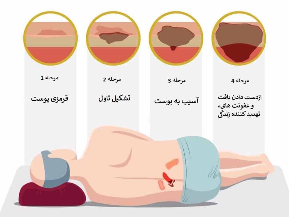 زخم بستر چیست و چگونه ایجاد می‌شود؟